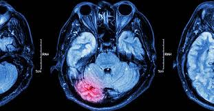 Concussion MRI