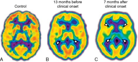 Fatal Familial Insomnia Brain Scan